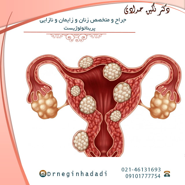فیبروم رحم - دکتر نگین حدادی
