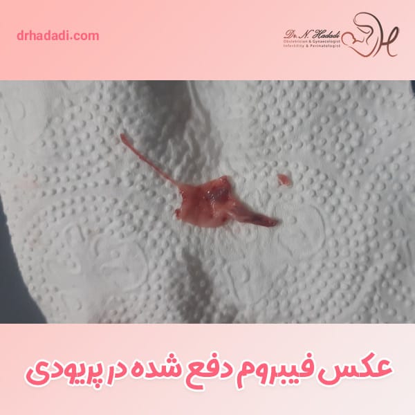 عکس فیبروم دفع شده در پریودی - دکتر نگین حدادی