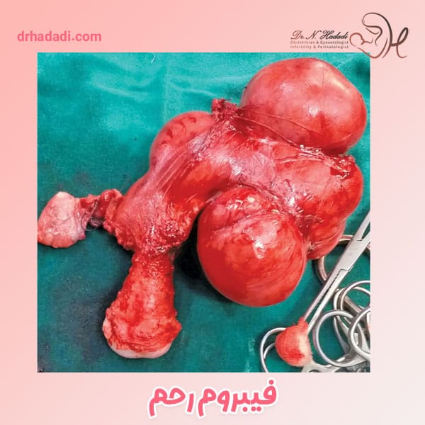 فیبروم رحم - دکتر نگین حدادی
