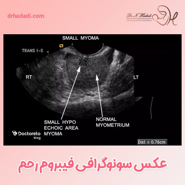 عکس سونوگرافی فیبروم رحم - دکتر نگین حدادی