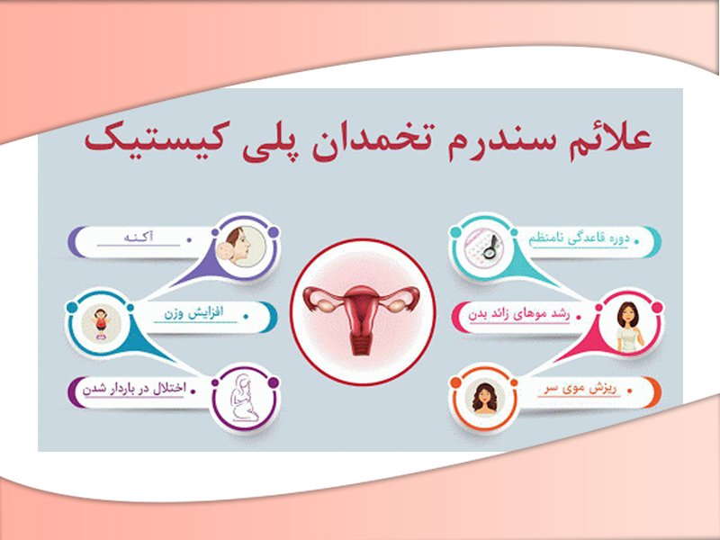 علائم سندرم تخمدان پلی کیستیک