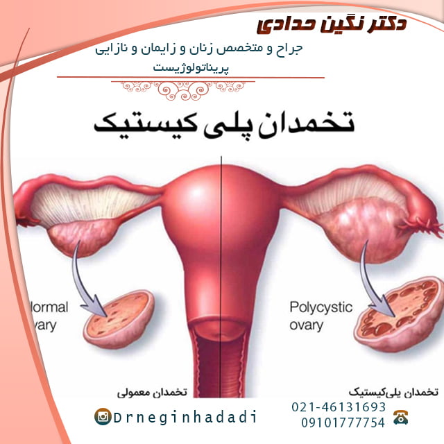 درمان تخمدان پلی کیستیک