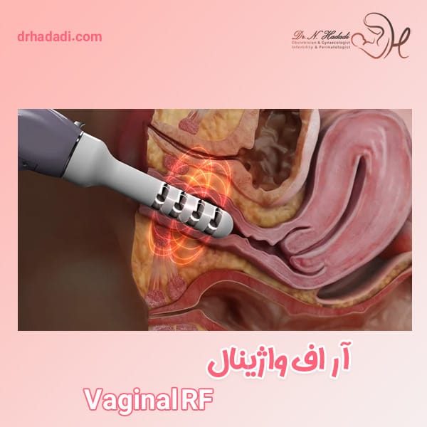 دستگاه آر اف وازینال - دکتر نگین حدادی