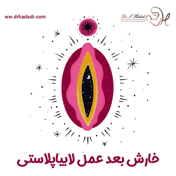 خارش بعد از عمل لابیاپلاستی - دکتر نگین حدادی