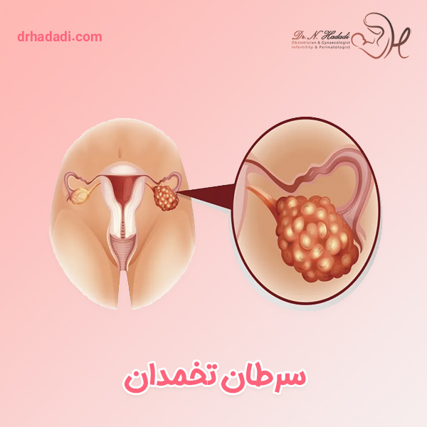 سرطان تخمدان - دکتر نگین حدادی