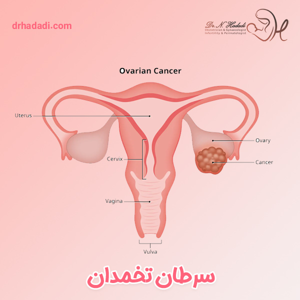 سرطان تخمدان و درمان قطعی آن