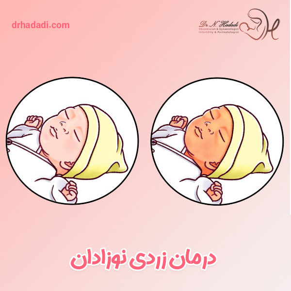 زردی نوزاد - دکتر نگین حدادی