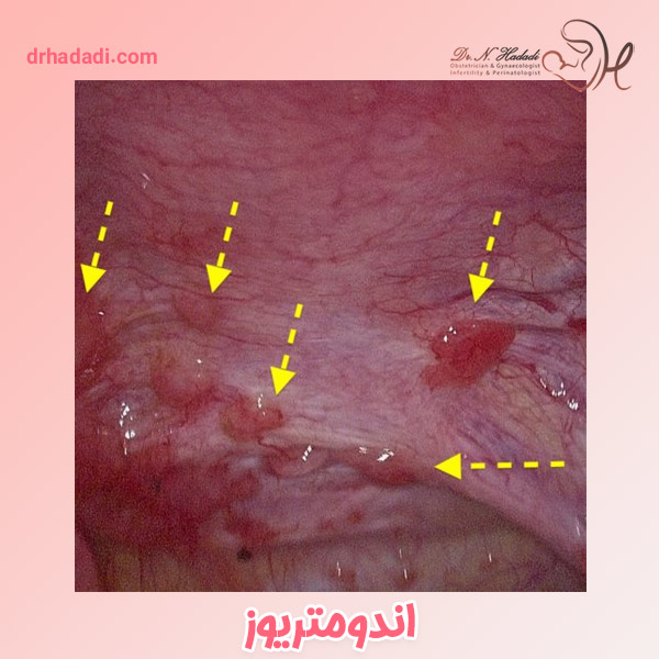 اند.متریوز - دکتر نگین حدادی