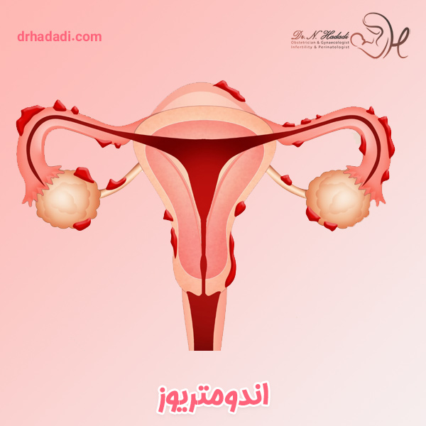 تشخیص و درمان اندومتریوز  | تصاویری از اندومتریوز