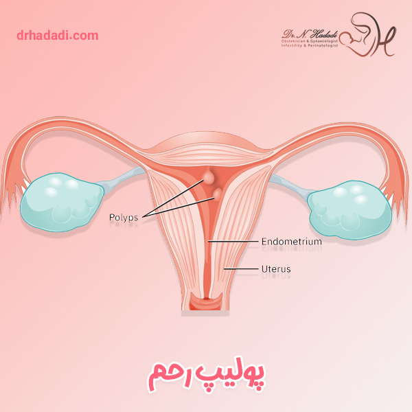 پولیپ رحم | دکتر نگین حدادی