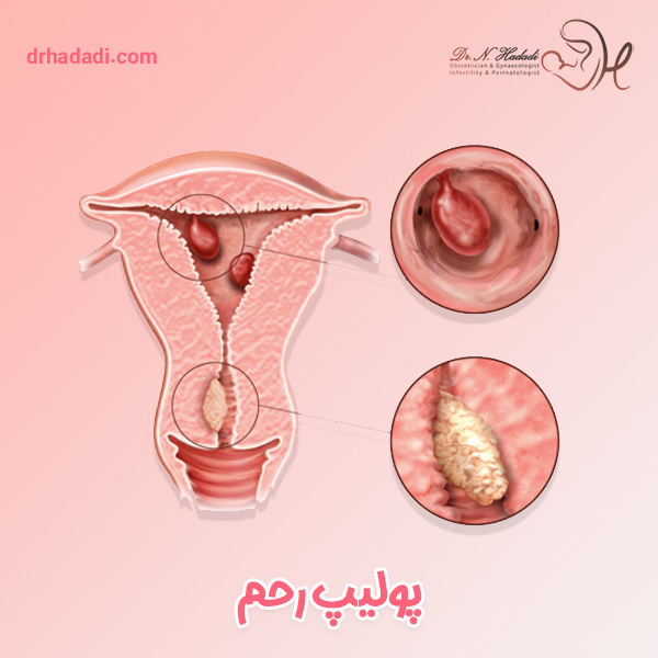 پولیپ رحم چیست و چگونه درمان میشود ؟