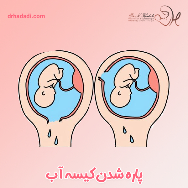 پاره شدن کیسه آب - دکتر نگین حدادی