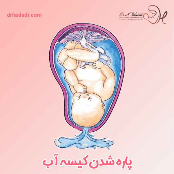 پاره شده کیسه آب جنین