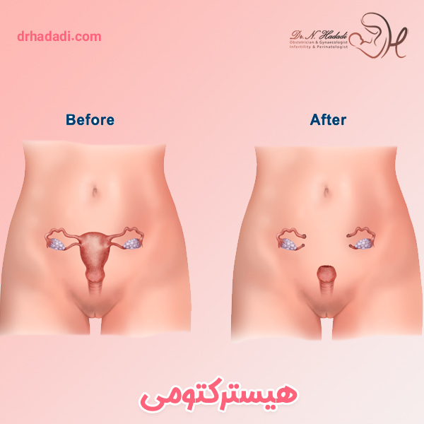 هیسترکتومی - دکتر نگین حدادی