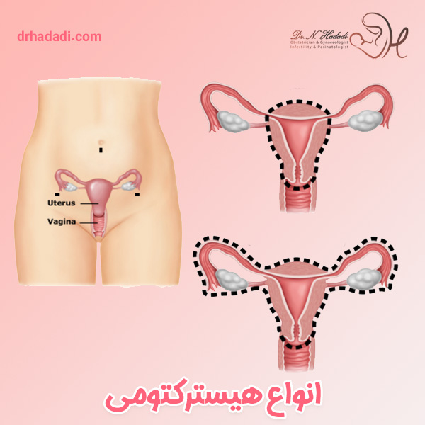 هیسترکتومی - دکتر نگین حدادی