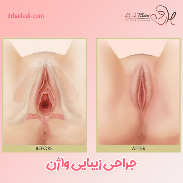 جراحی تنگ کردن - دکتر نگین حدادی