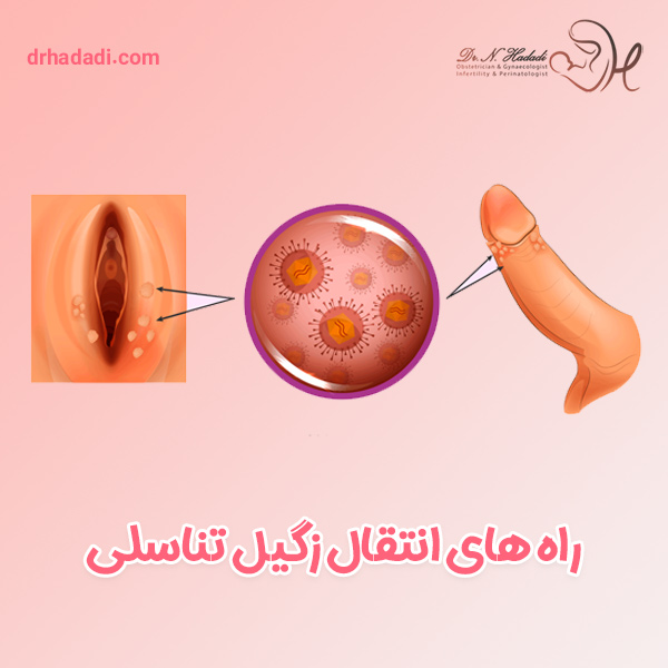 راه های انتقال زگیل تناسلی - دکتر نگین حدادی