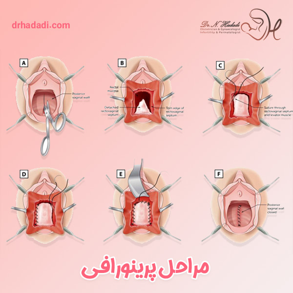 پرینورافی - دکتر نگین حدادی