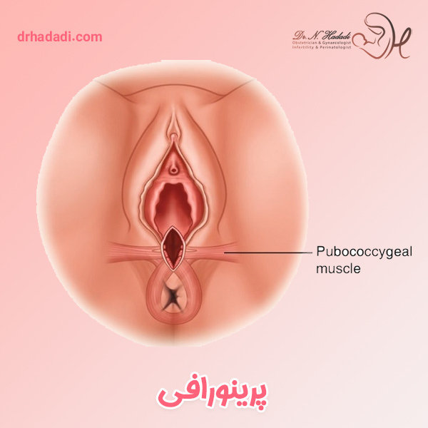 عمل پرینورافی چیست و چه کاربردهایی دارد؟