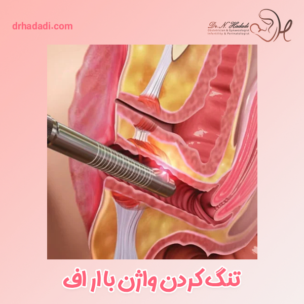 تنگ کردن واژن با آر اف | مزایا و عوارض