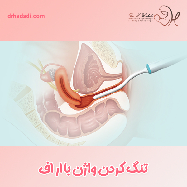 تنگ کردن واژن با آر اف - دکتر نگین حدادی