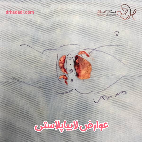 عوارض عمل لابیاپلاستی - دکتر نگین حدادی