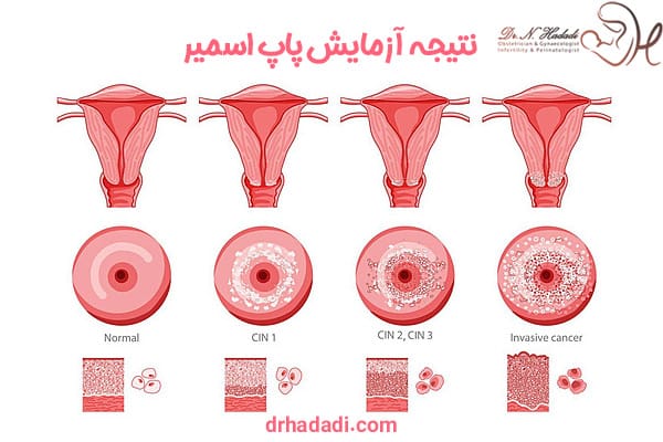 آزمایش پاپ اسمیر - دکتر نگین حدادی