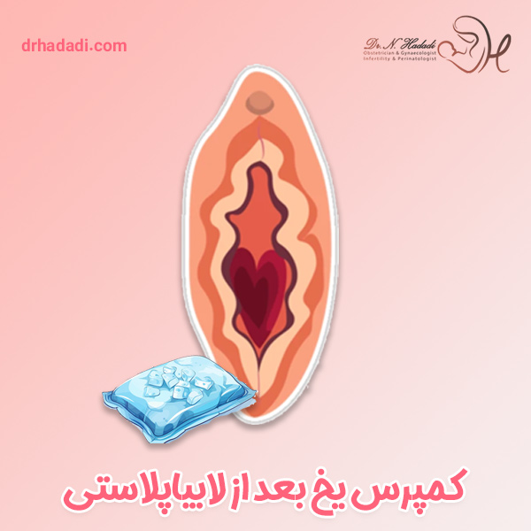 کمپرس یخ بعد از لابیاپلاستی - دکتر نگین حدادی