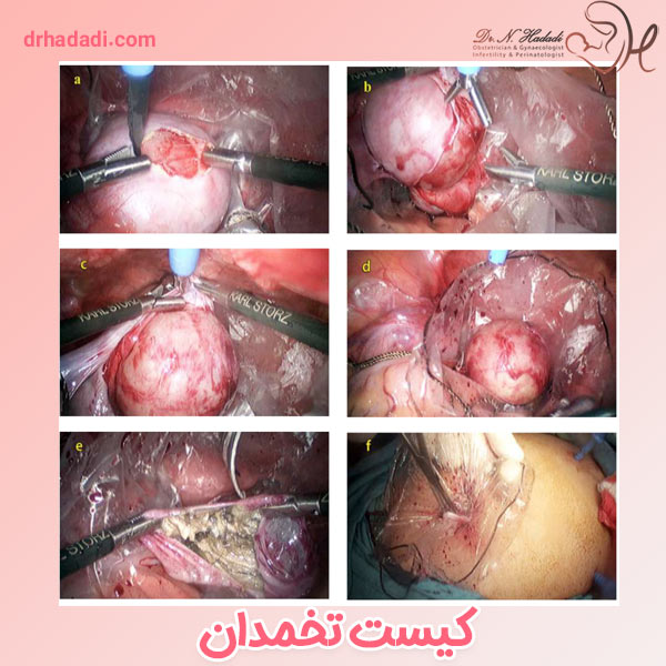 کیست تخمدان - دکتر نگین حدادی