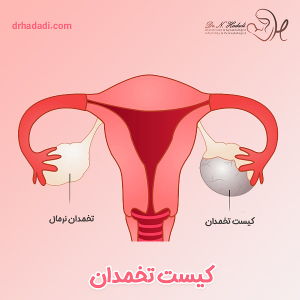 کیست تخمدان - دکتر حدادی