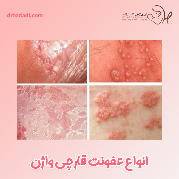 عفونت قارچی واژن - دکتر نگین حدادی