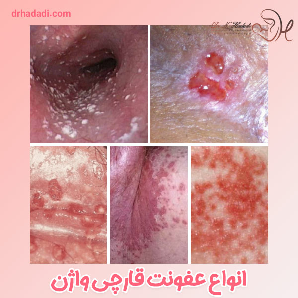 عفونت قارچی واژن - دکتر نگین حدادی
