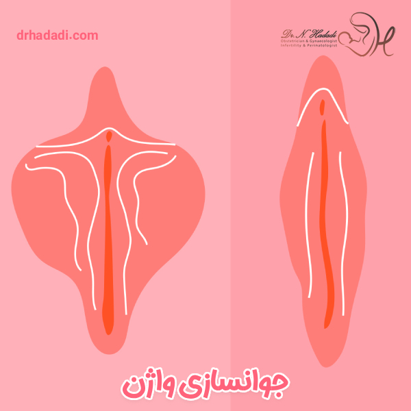 جوانسازی واژن - دکتر نگین حدادی