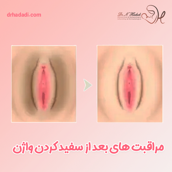 مراقبت های بعد از سفید کردن واژن