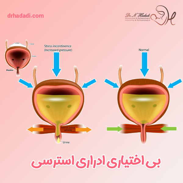 بی اختیاری ادراری استرسی - دکتر نگین حدادی
