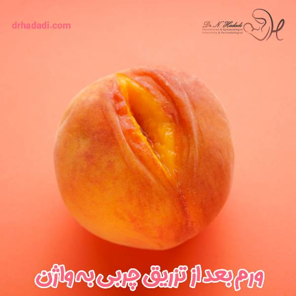 ورم بعد از تزریق چربی به واژن - دکتر نگین حدادی