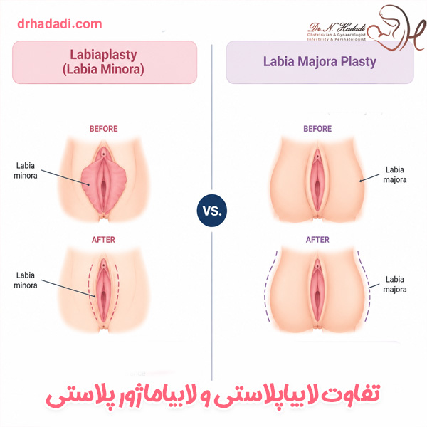 تفاوت لابیاپلاستی و لابیاماژورپلاستی