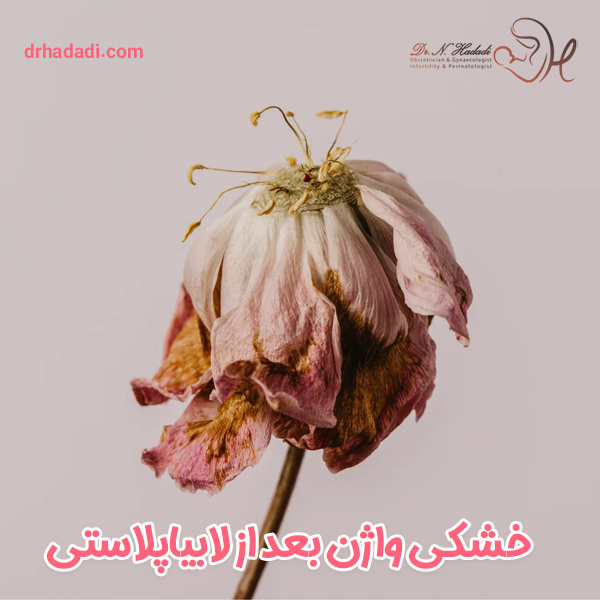 خشکی واژن بعد از لابیاپلاستی - دکتر نگین حدادی