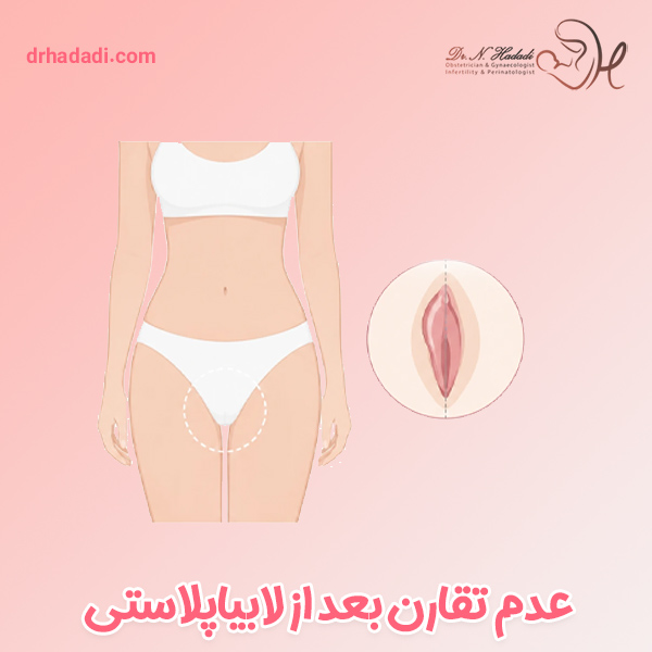 عدم تقارن لابیا بعد از  عمل لابیاپلاستی
