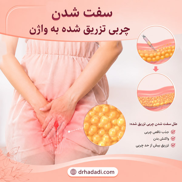 سفت شدن چربی تزریق شده به واژن - دکتر نگین حدادی
