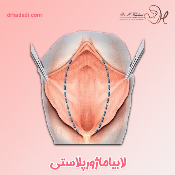 لابیاماژورپلاستی - دکتر نگین حدادی