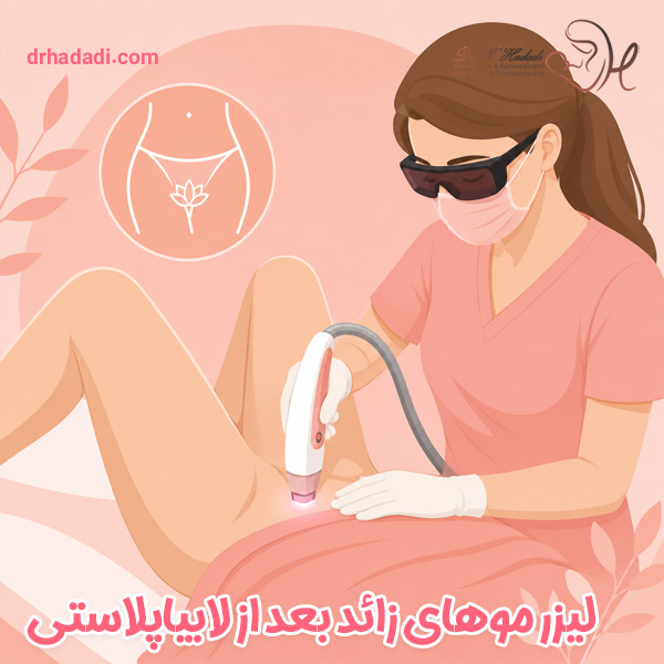 لیزر موهای زائد بعد از لابیاپلاستی