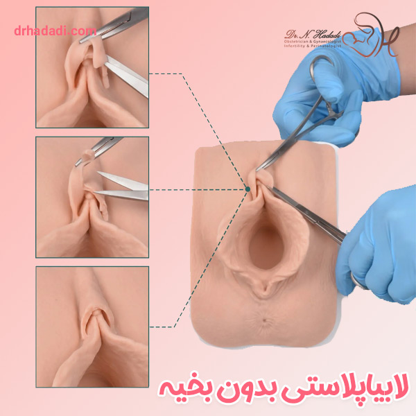 لابیاپلاستی بدون بخیه - دکتر حدادی